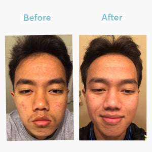 Dark Spot Remover _ MDacne.jpeg