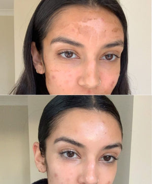 Explore Privee Clinic for the best peel for….jpeg