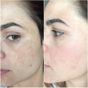 How To Get Rid Of Dark Spots Around Mouth.jpeg