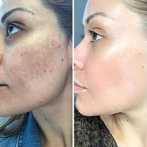 How To Remove Dark Spots On Face Overnight Home….jpeg