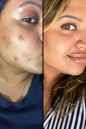 How to Fade Dark Spots and Hyperpigmentation….jpeg