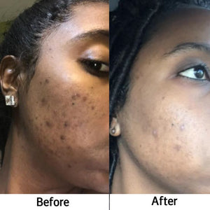 Kojic acid soap helps with hyperpigmentation and….jpeg