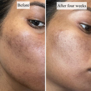 Remedy For Dark Spots Review With Photos _ PS….jpeg